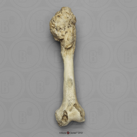 Human Left femur, Osteosarcoma