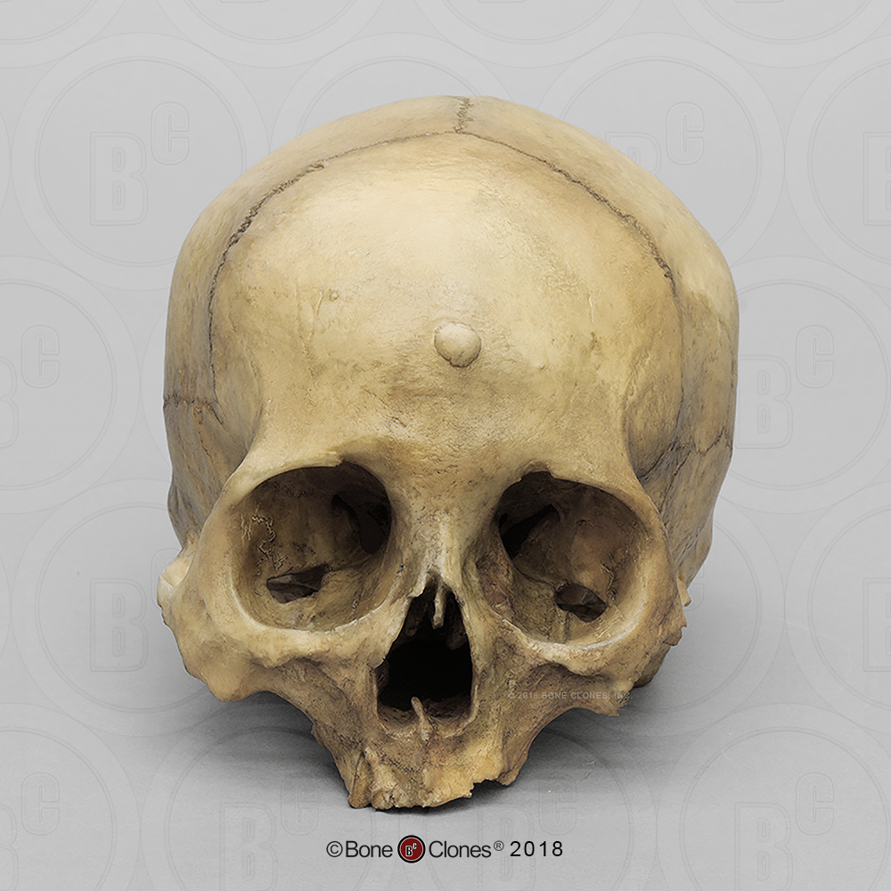 Human Female Skull with Button Osteoma - Bone Clones, Inc