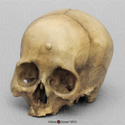 Human Female Cranium with Button Osteoma