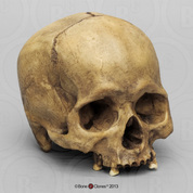 Human Male Skull with Porotic Hyperostosis