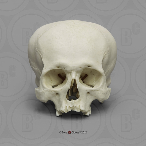 Human Male Cranium, Cranial Deformation