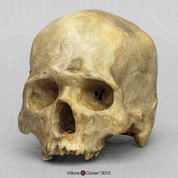 Human Male Skull with Healed Frontal Bone Fracture and Inca Bone