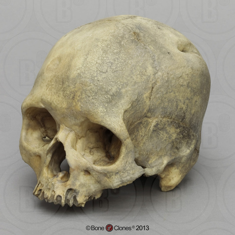 Human Male Cranium with Healed Parietal Bone Fracture