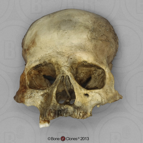 Human Female Partial Skull with Cribra Orbitalia