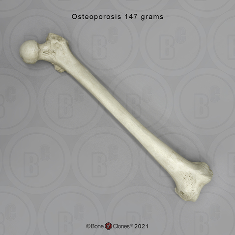 Human Adult Female Femur, Osteoporosis