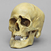 Human Male Skull with a 32-caliber Gunshot Wound
