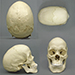 Human Female Scaphocephalic Skull