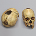 Human Female Skull with Shotgun Wounds