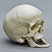 Human Female Achondroplasia Dwarf Skull