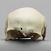 Human Female Partial Skull with Shotgun Pellets Embedded