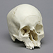 Human Blunt Force Trauma Eye Orbit Skull