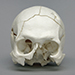 Human Male Skull Classic Entry-Exit Gunshot Wounds