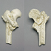 Human Adult Remote Hip Fracture