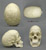 Human Female Scaphocephalic Skull