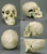 Human Female Skull with Multiple Gunshot Wounds