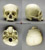 Human Adult Cradle-boarded Skull